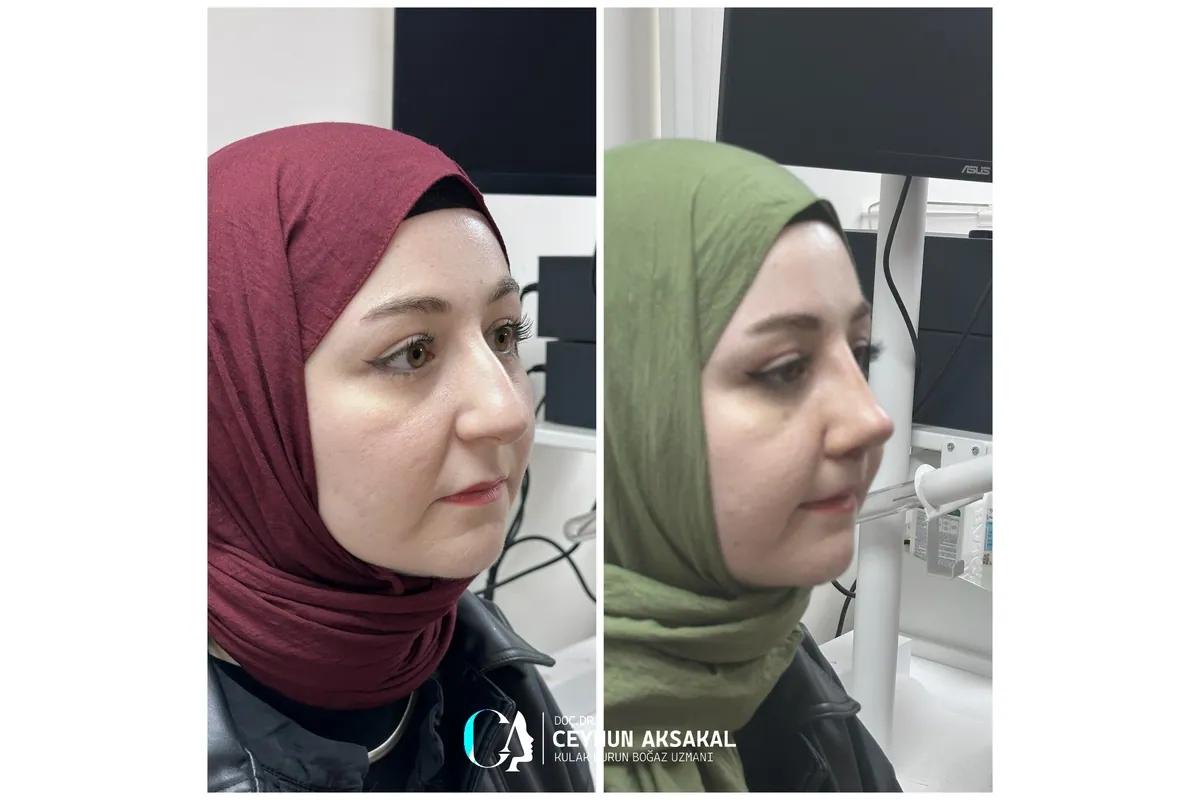 Rinoplasti öncesi ve sonrası örneği 8