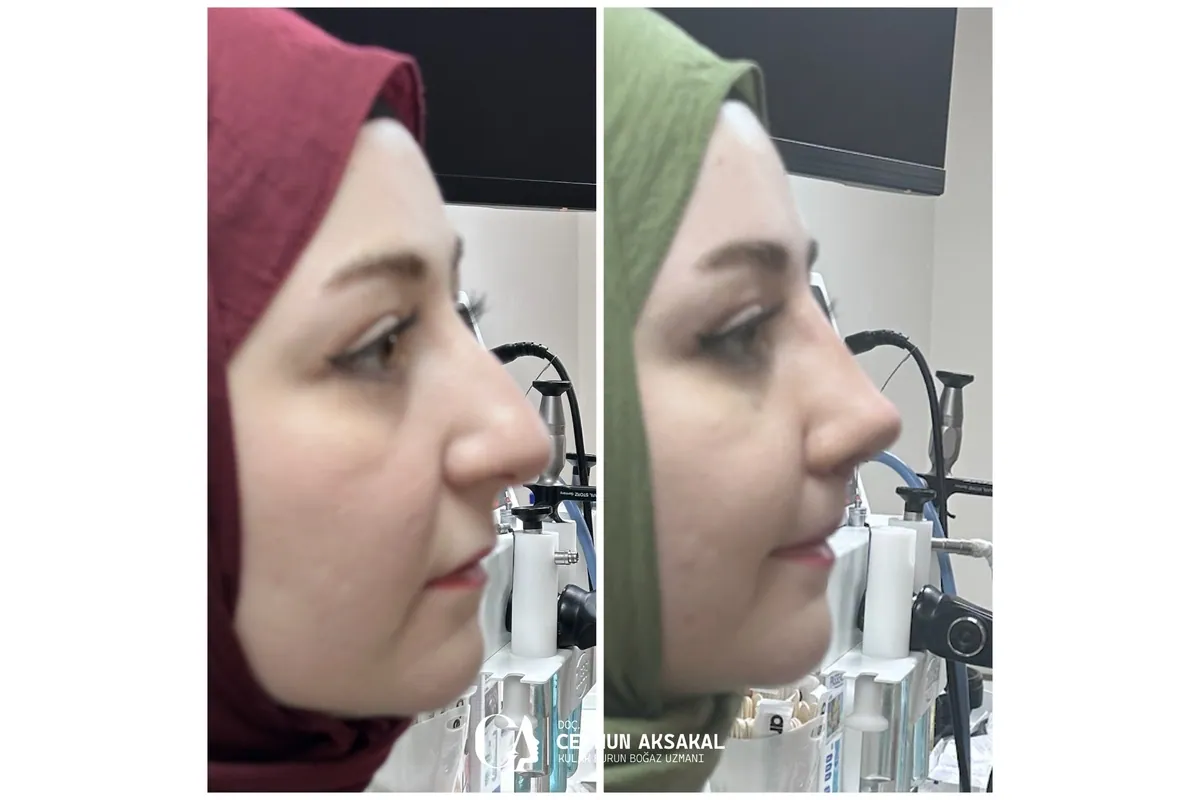 Rinoplasti öncesi ve sonrası örneği 9